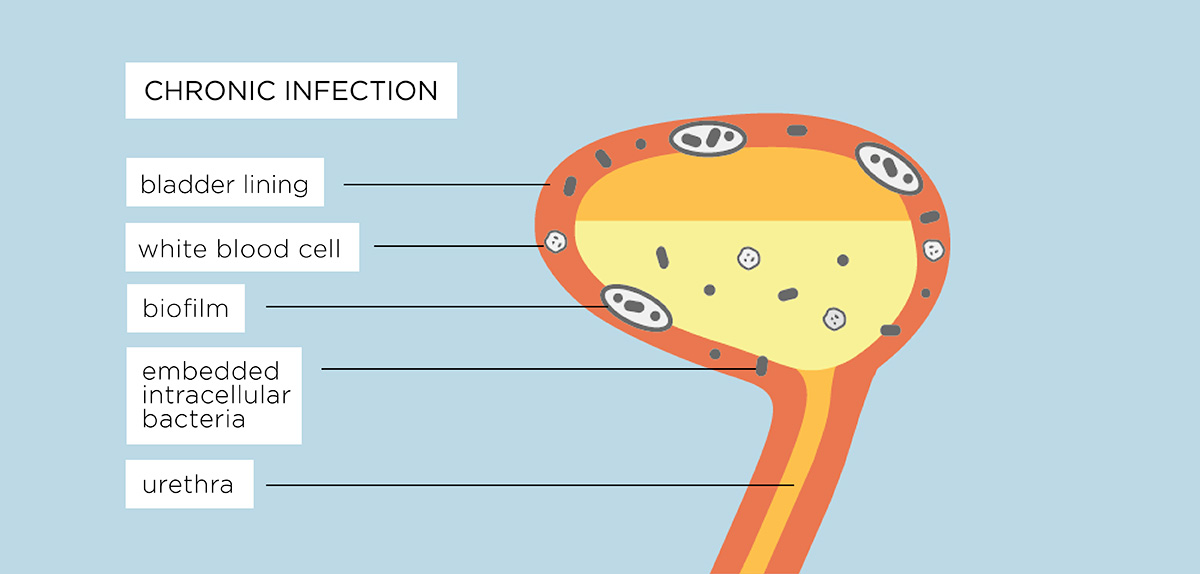 the bladder with a chronic urinary tract infection